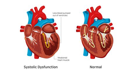 unspecified systolic congestive heart failure